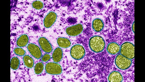 monkeypox virus, shown here in a colored electron micrograph