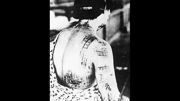 A Japanese woman who was an atomic bomb burn victim